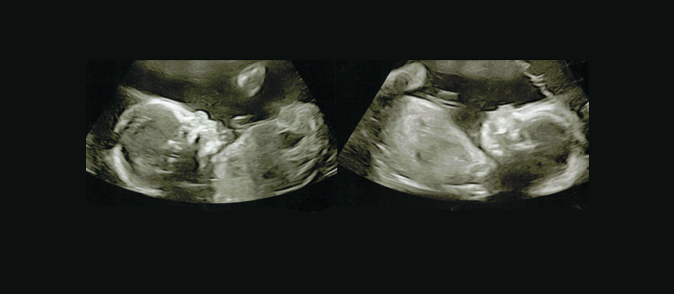 Ultrasound images of Axelrod Twins